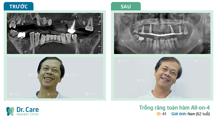 Khắc phục hậu quả tiêu xương hàm bằng phương pháp trồng răng Implant