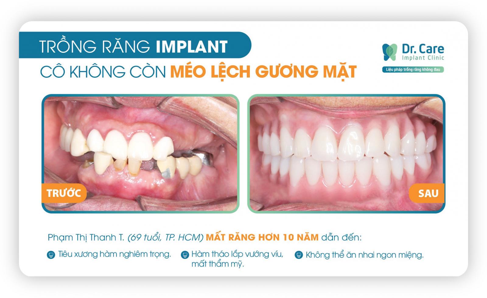 Thời gian trồng răng bằng trụ Implant Global D In – Kone là bao lâu?