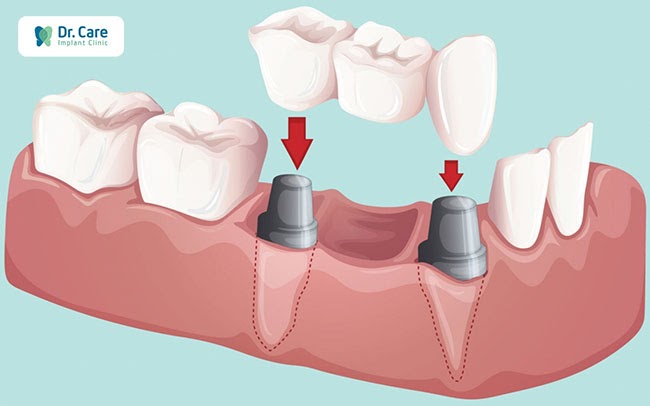 Tìm hiểu về phương pháp làm cầu răng sứ kỹ lưỡng