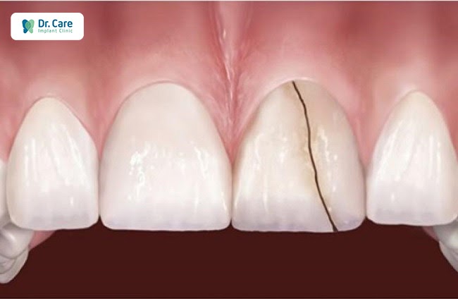 Cầu răng sứ bị mẻ và tác hại?