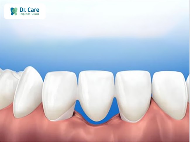 Dấu hiệu nhận biết cầu răng sứ gây hôi miệng và các bệnh lý răng miệng