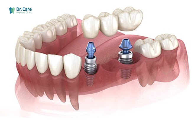 Quy trình làm cầu răng sứ và quy trình làm răng Implant