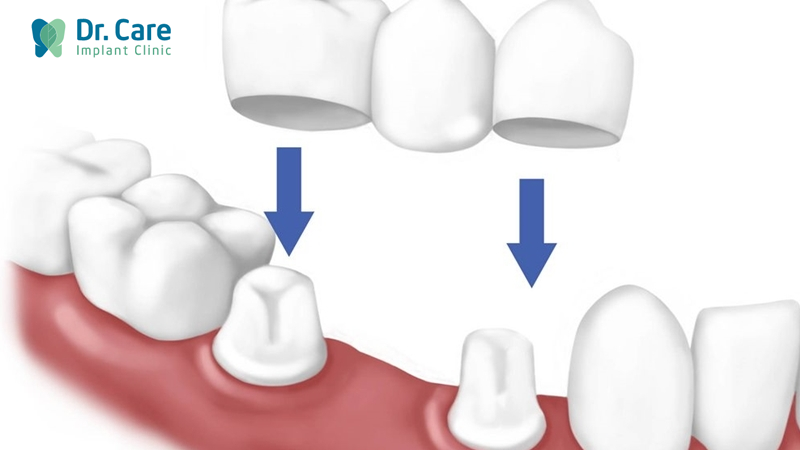 Phương pháp cầu răng sứ