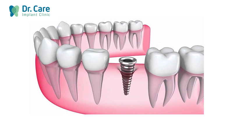 Trồng răng Implant-phục hình răng số 5 tốt nhất