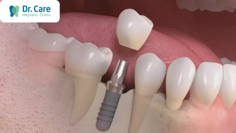 Mất răng số 6 khắc phục như thế nào?