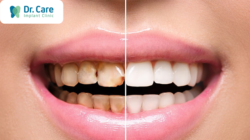 So sánh chi phí răng sứ Ceramco và những loại răng sứ khác