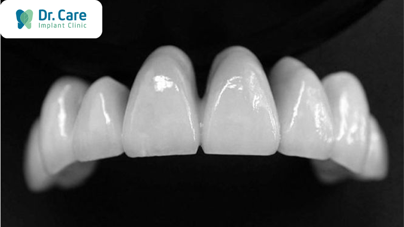 3 Ưu điểm của răng sứ Dmax