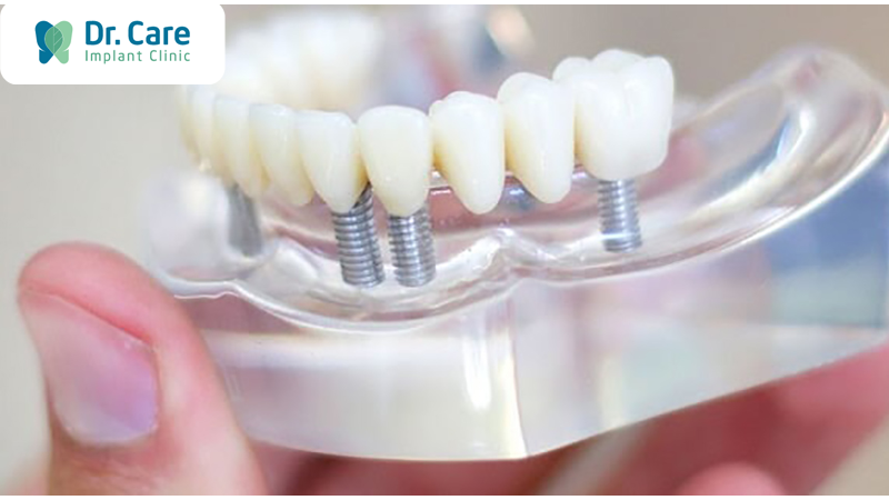 Răng sứ Emax CAD