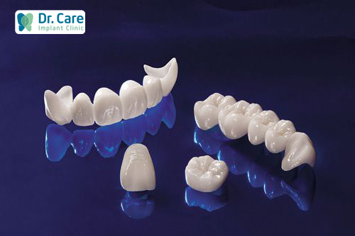 Răng tạm trên Implant là gì?