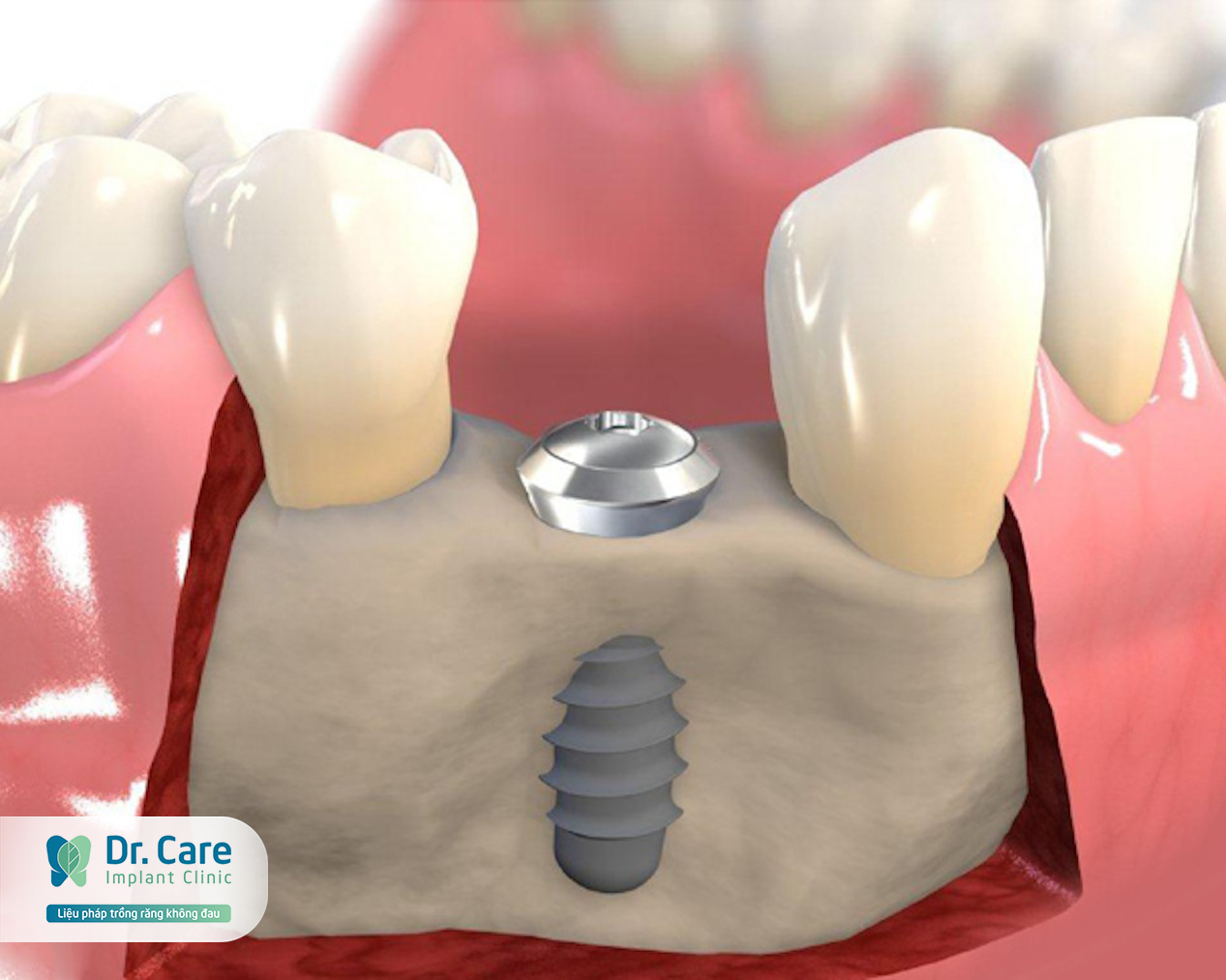 Trồng răng Implant điều trị tiêu xương hàm trên hiệu quả