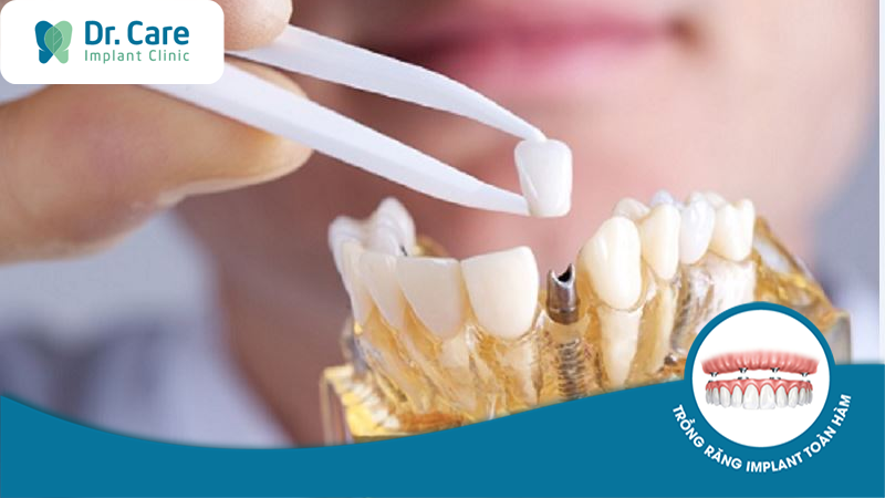 Tìm hiểu về kỹ thuật trồng răng Implant