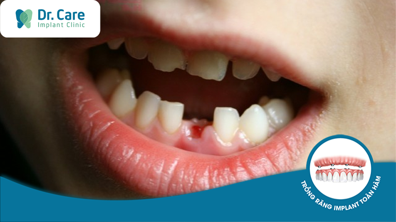 Trẻ em trồng răng Implant có được không?