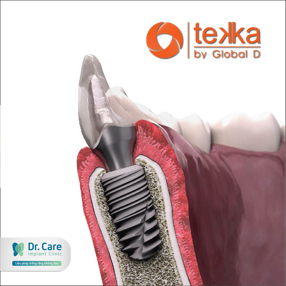 Trụ Implant Tekka Global D (Pháp)