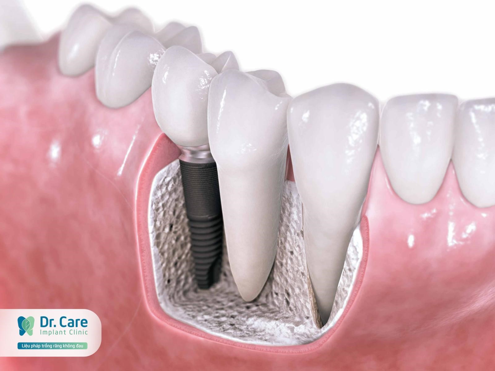 Thời gian cấy trụ Implant Neodent