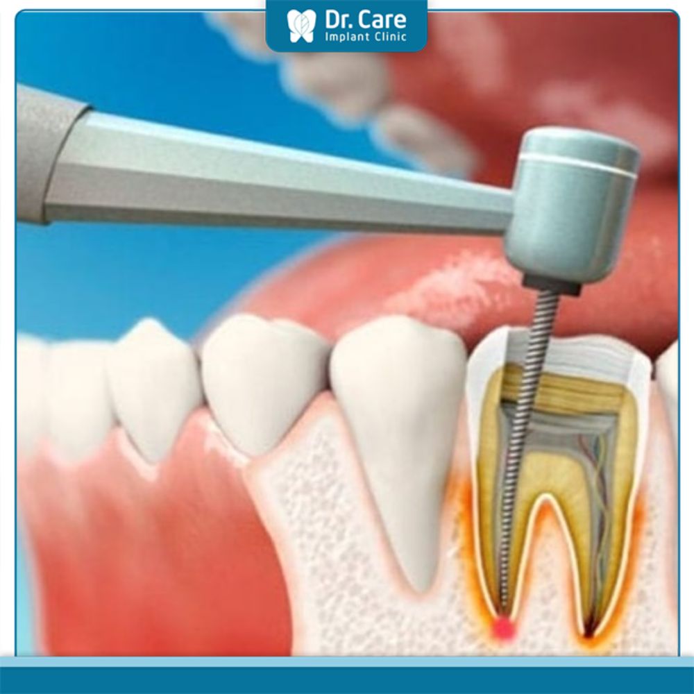 Làm sao để hạn chế tác hại của việc lấy chỉ máu răng