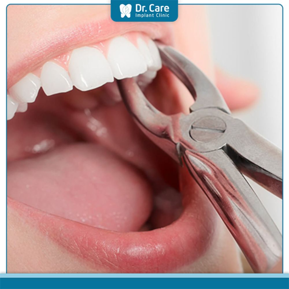 Rủi ro của việc lấy chỉ máu răng