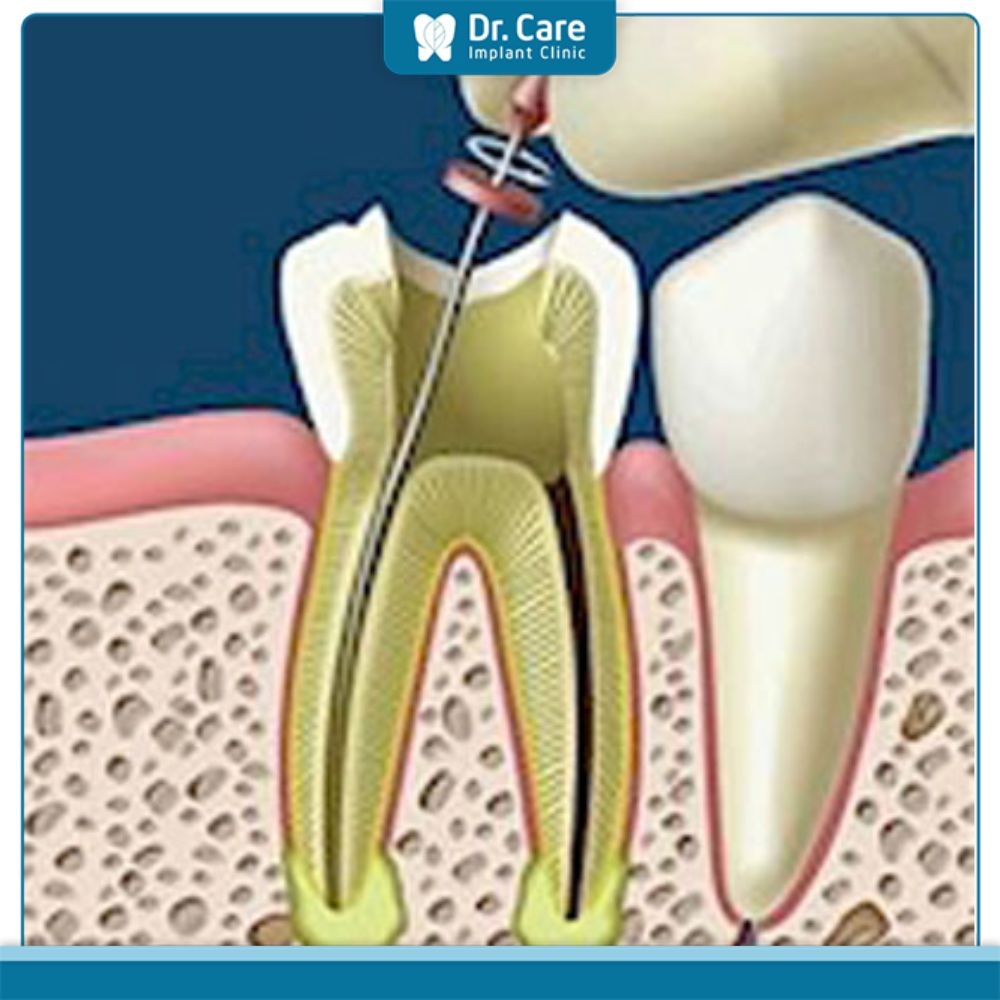 Thời gian lấy tủy răng mất bao lâu?