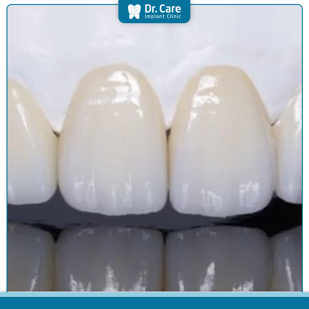 Răng thưa ở vị trí nào thì nên bọc răng sứ?