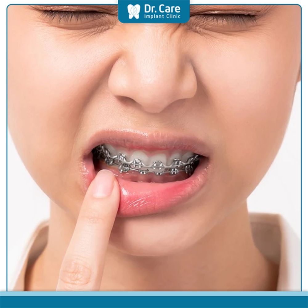 Cắm vít niềng răng quá lâu có sao không?