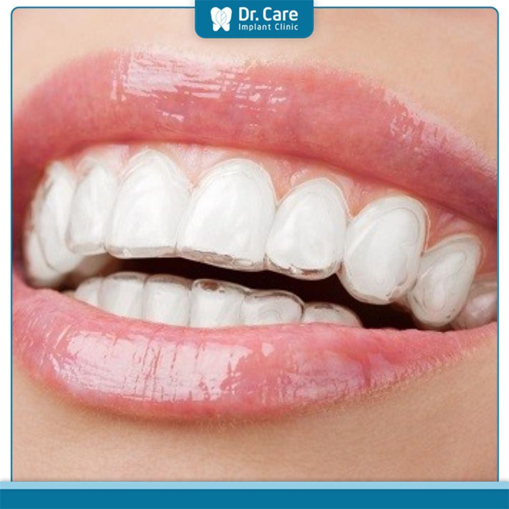 Tháo vít niềng răng trước thời hạn có ảnh hưởng gì không?