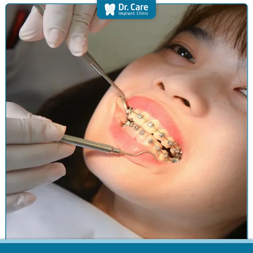 Quy trình tháo niềng cắm vít diễn ra như thế nào