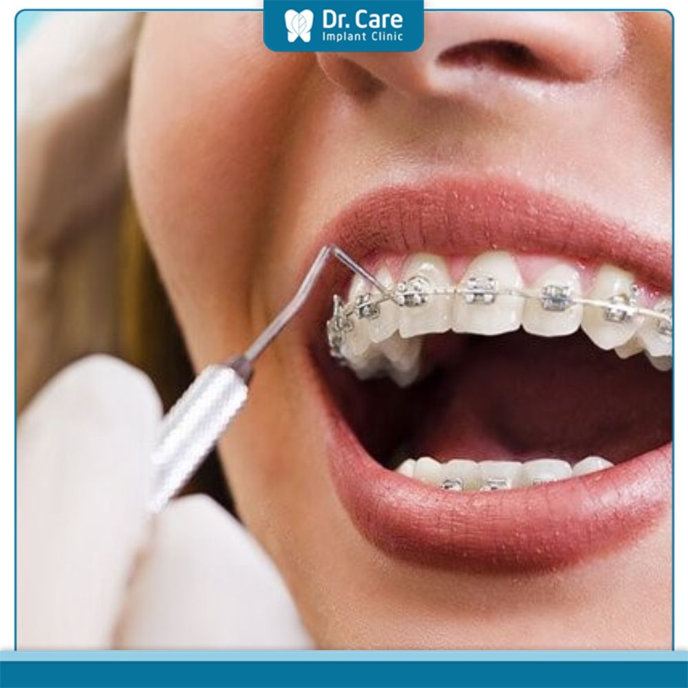 Tháo vít niềng răng trước thời hạn có ảnh hưởng gì không?