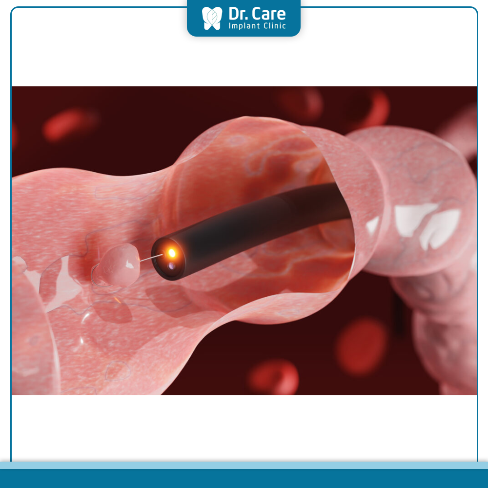 Tầm soát ung thư vòm họng thông qua nội soi tai mũi họng