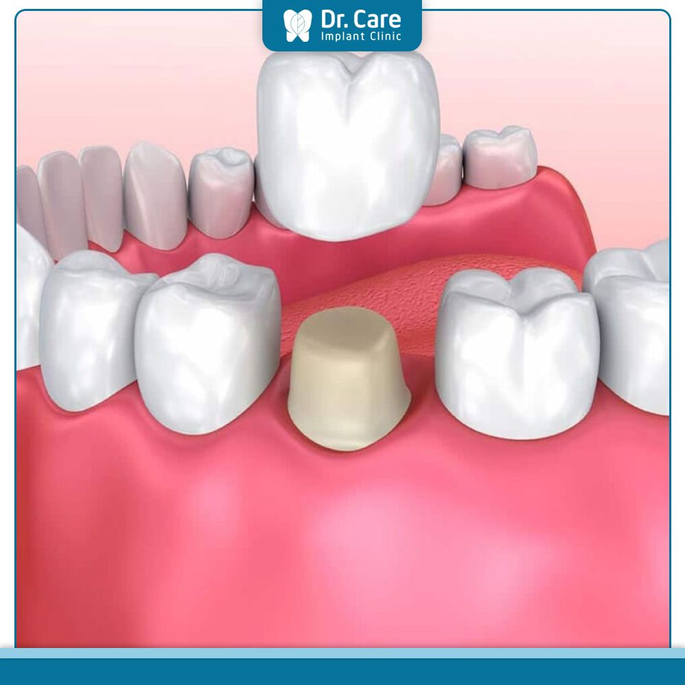 Bọc răng sứ bắt buộc phải mài đi một phần răng thật để làm trụ răng