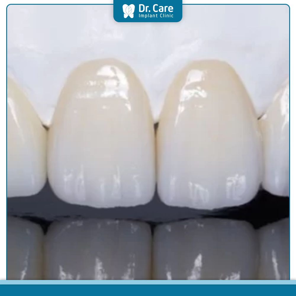 Kỹ thuật bọc sứ giúp khắc phục các khuyết điểm như răng thưa, ố vàng, lệch, hô, móm nhẹ
