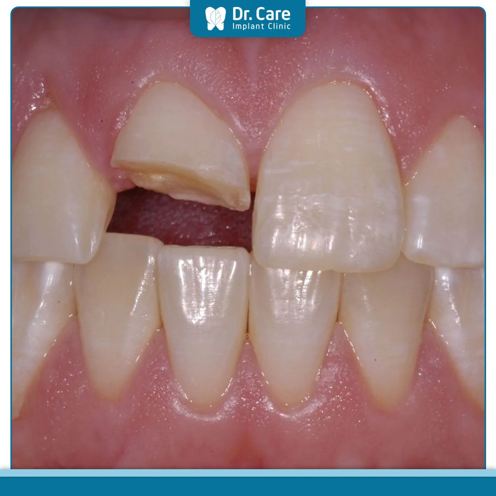 Các yếu tố ảnh hưởng đến chi phí bọc sứ răng cửa