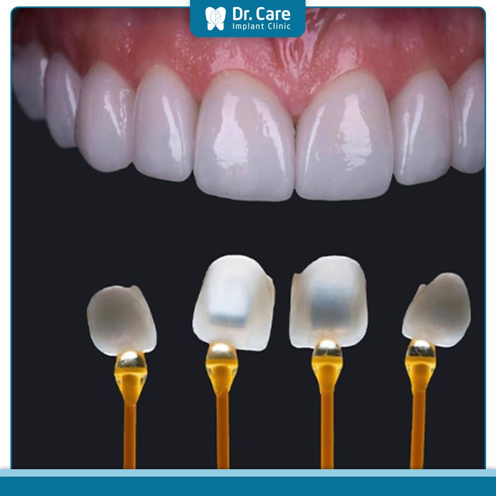 Veneer là lớp sứ mỏng được dán lên bề mặt răng để khắc phục các vấn đề như răng ố vàng, xỉn màu, thưa…