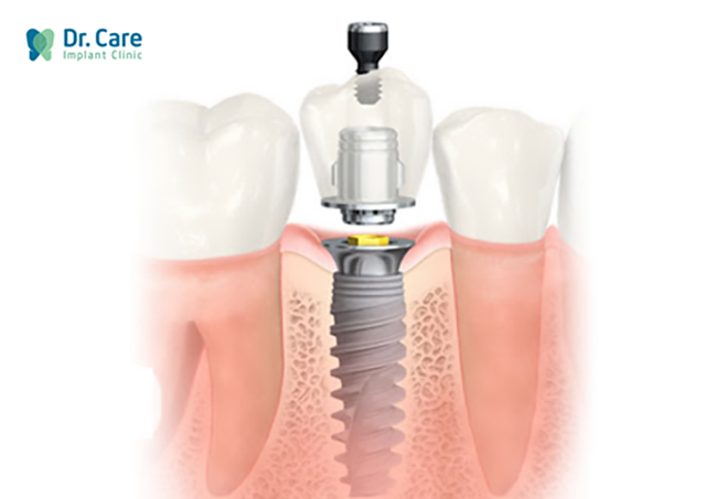 trụ implant nobel biocare, nên trồng răng implant loại nào