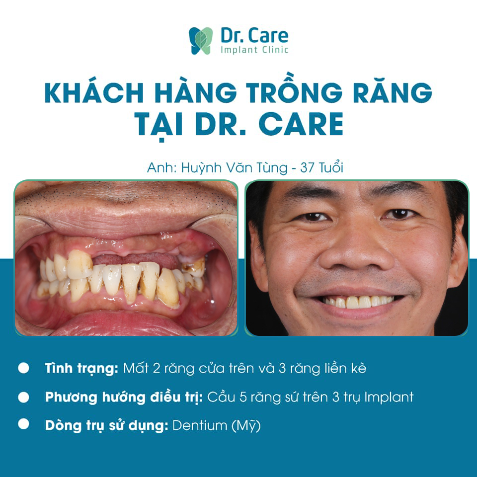 Khách hàng phục hồi 5 răng tại Dr. Care với giải pháp Implant