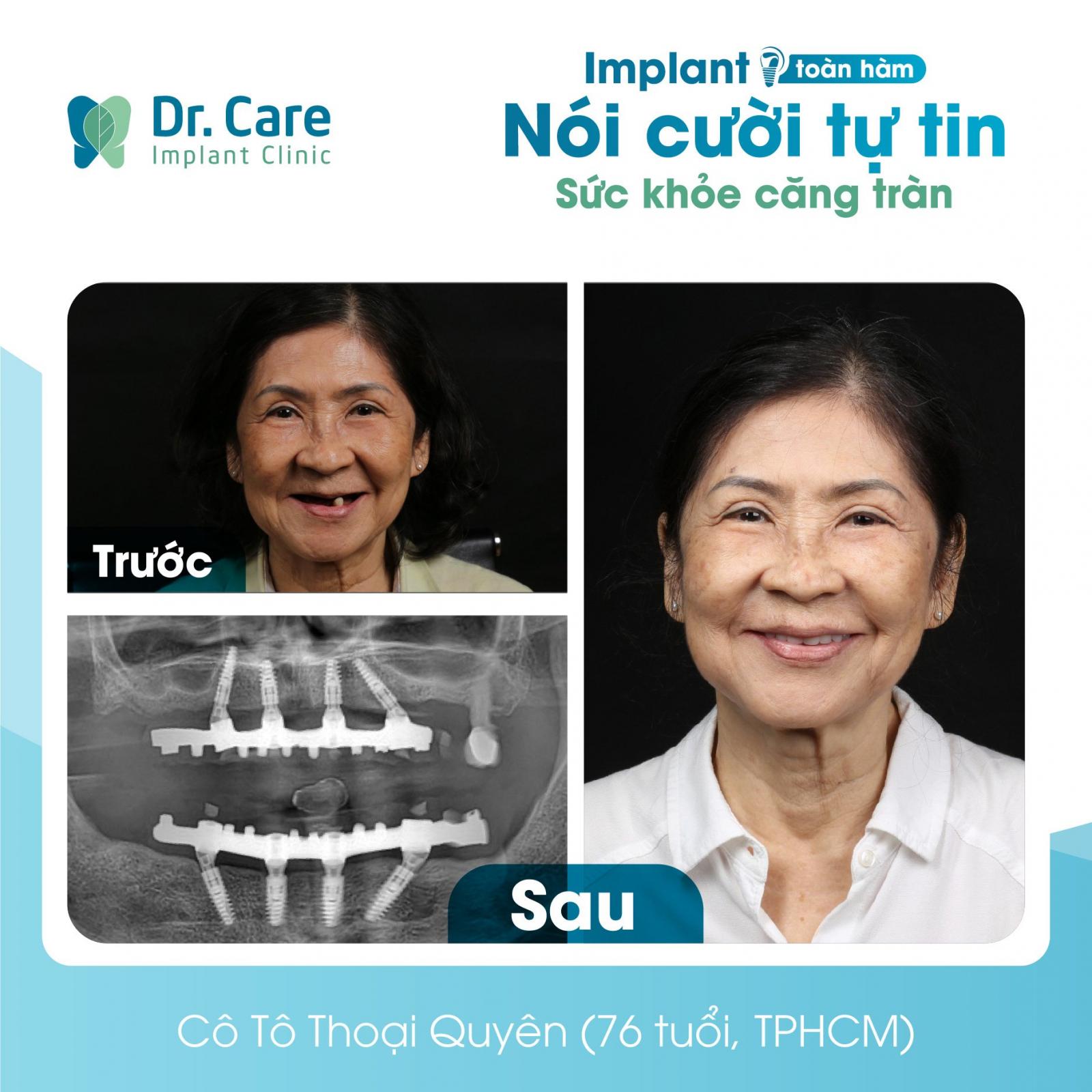  trồng Implant