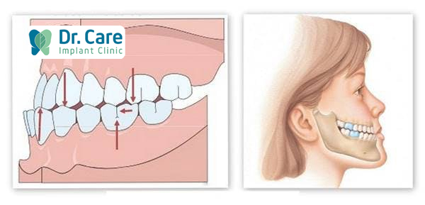 Nguyên nhân gây ra tình trạng lệch khớp cắn khi bọc răng sứ