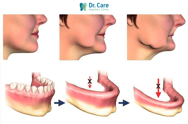 Hậu quả nghiêm trọng khi mất răng không còn chân răng 