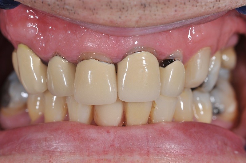 Những yếu tố ảnh hưởng đến chi phí bọc răng sứ