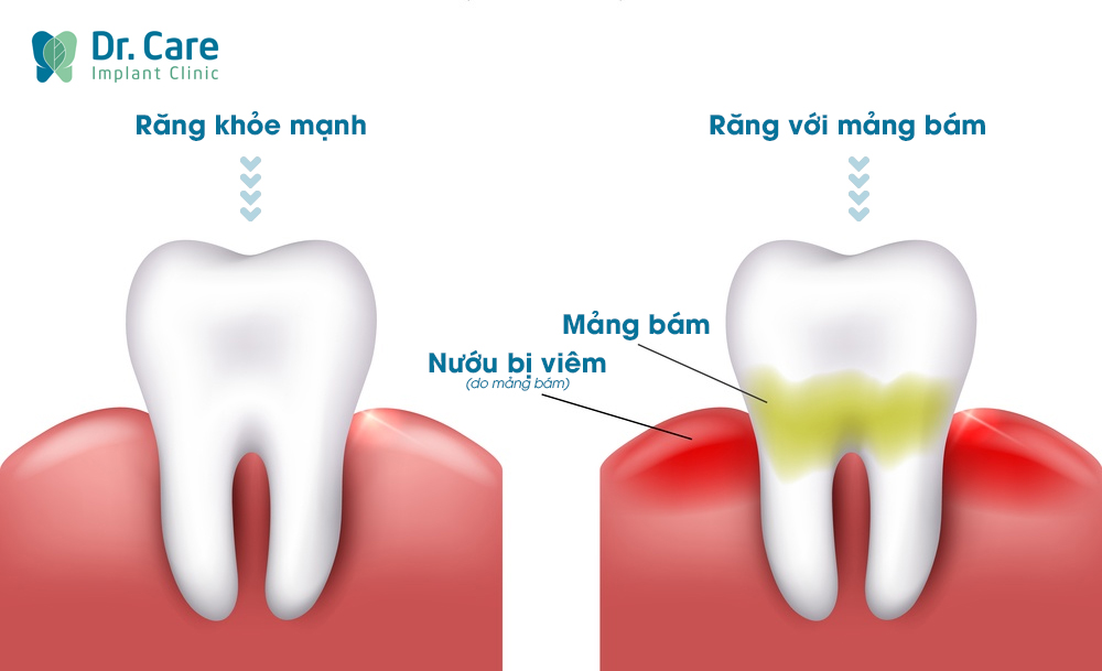 Mảng bám trên răng là gì
