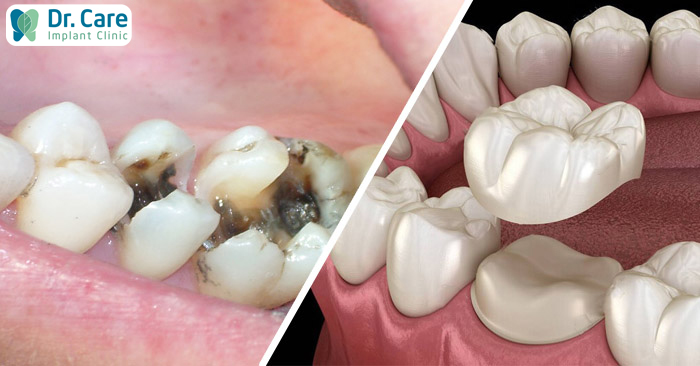 5 ưu điểm của bọc răng sứ bảo tồn: