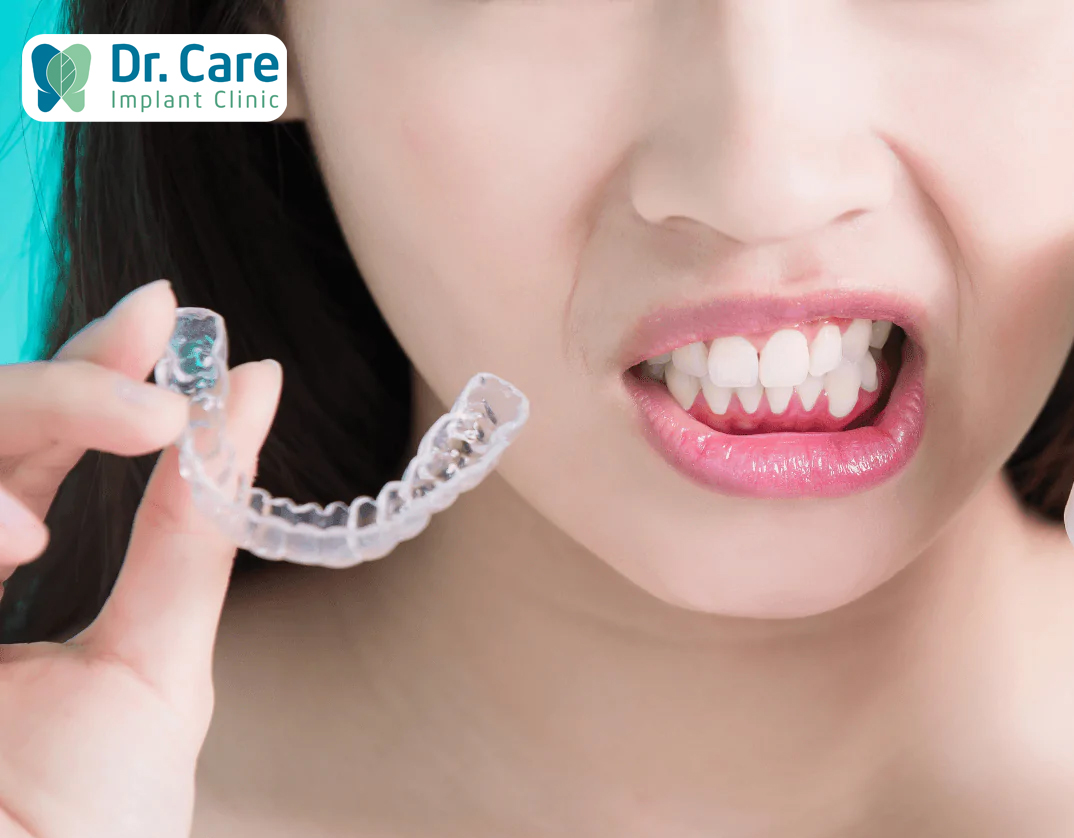 Dùng bảo vệ hàm để hạn chế ảnh hưởng do thói quen nghiến răng