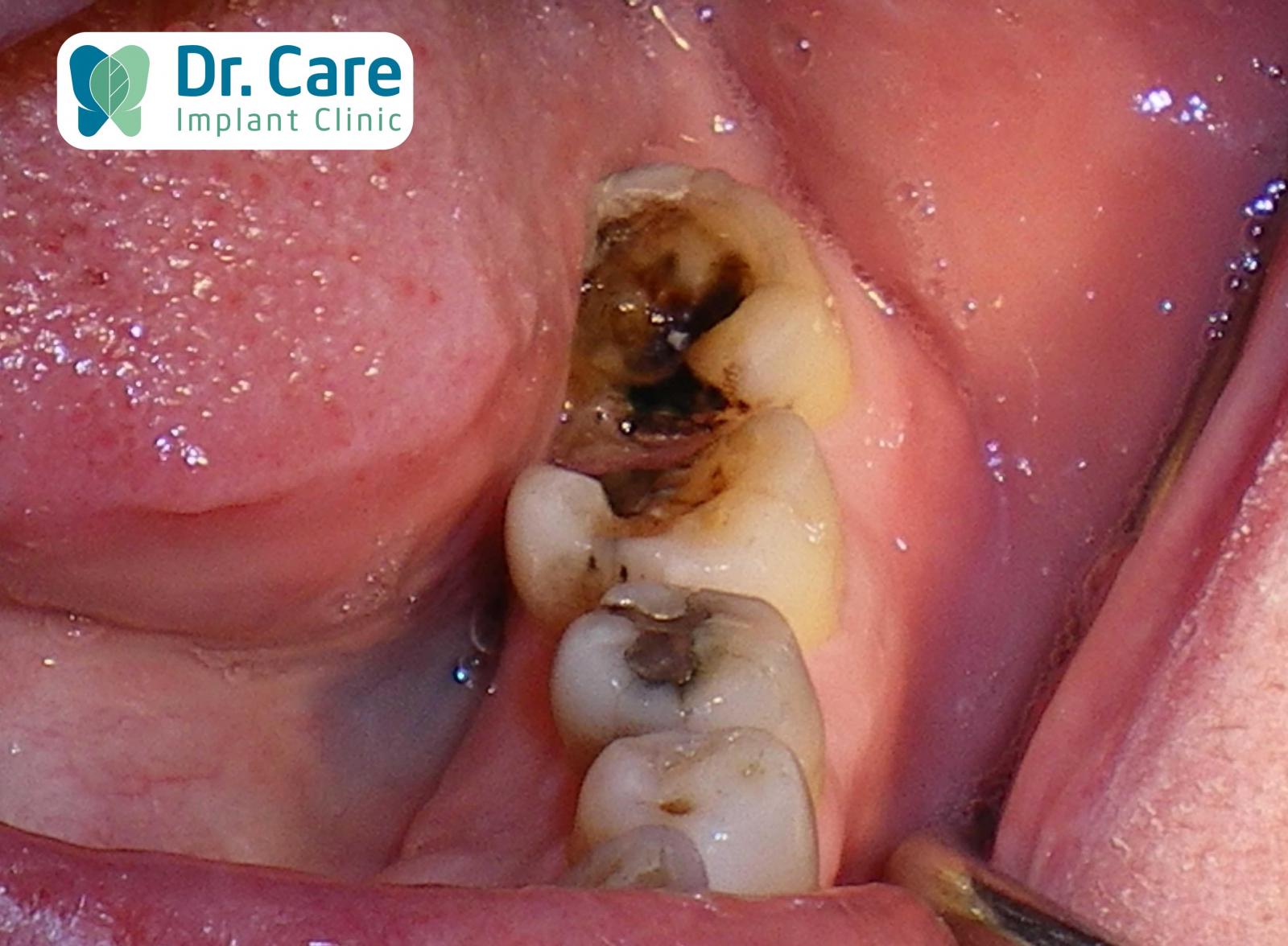 Biện pháp phòng ngừa viêm tủy răng số 8