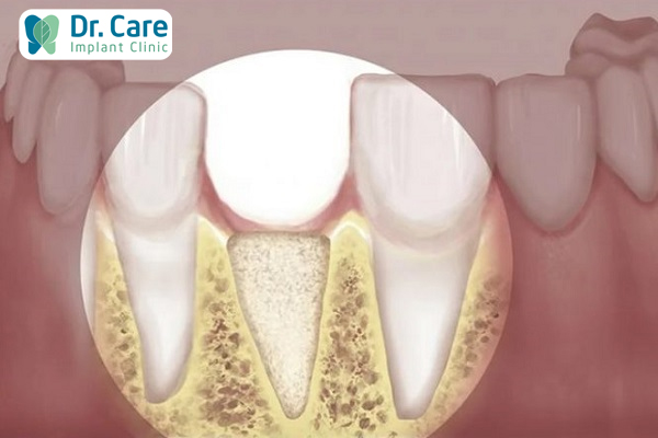 Biến chứng tiêu xương ổ răng dẫn đến xương hàm
