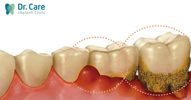 Cầu răng sứ Dễ gây các bệnh lý liên quan đến răng miệng như viêm nha chu, viêm lợi.