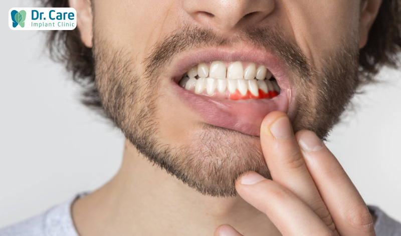 Áp xe răng dẫ đến chảy máu chân răng
