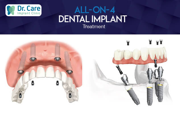 Trồng răng Implant toàn hàm All on - 4 là gì?
