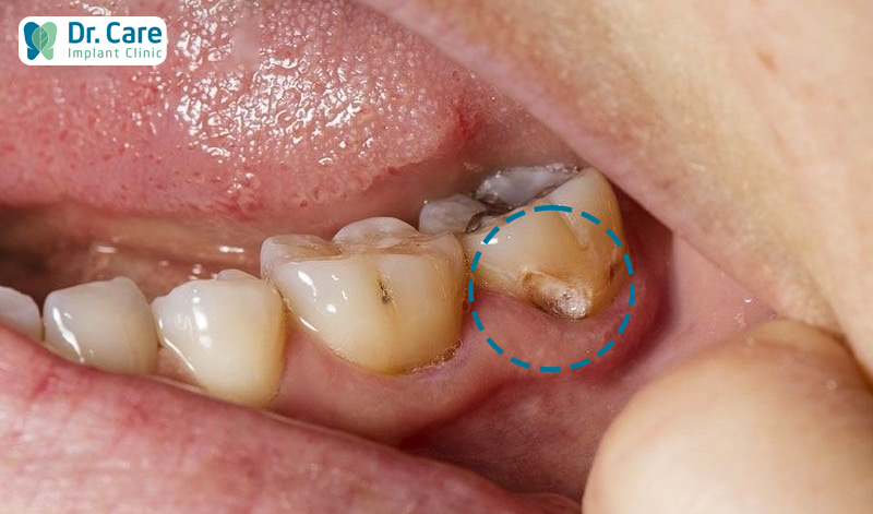 Sâu răng hàm dẫn đến sưng nướu răng trong cùng hàm dưới
