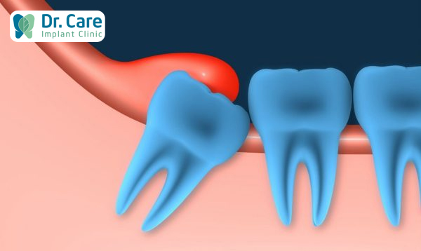 Dấu hiệu sưng nướu răng trong cùng hàm dưới