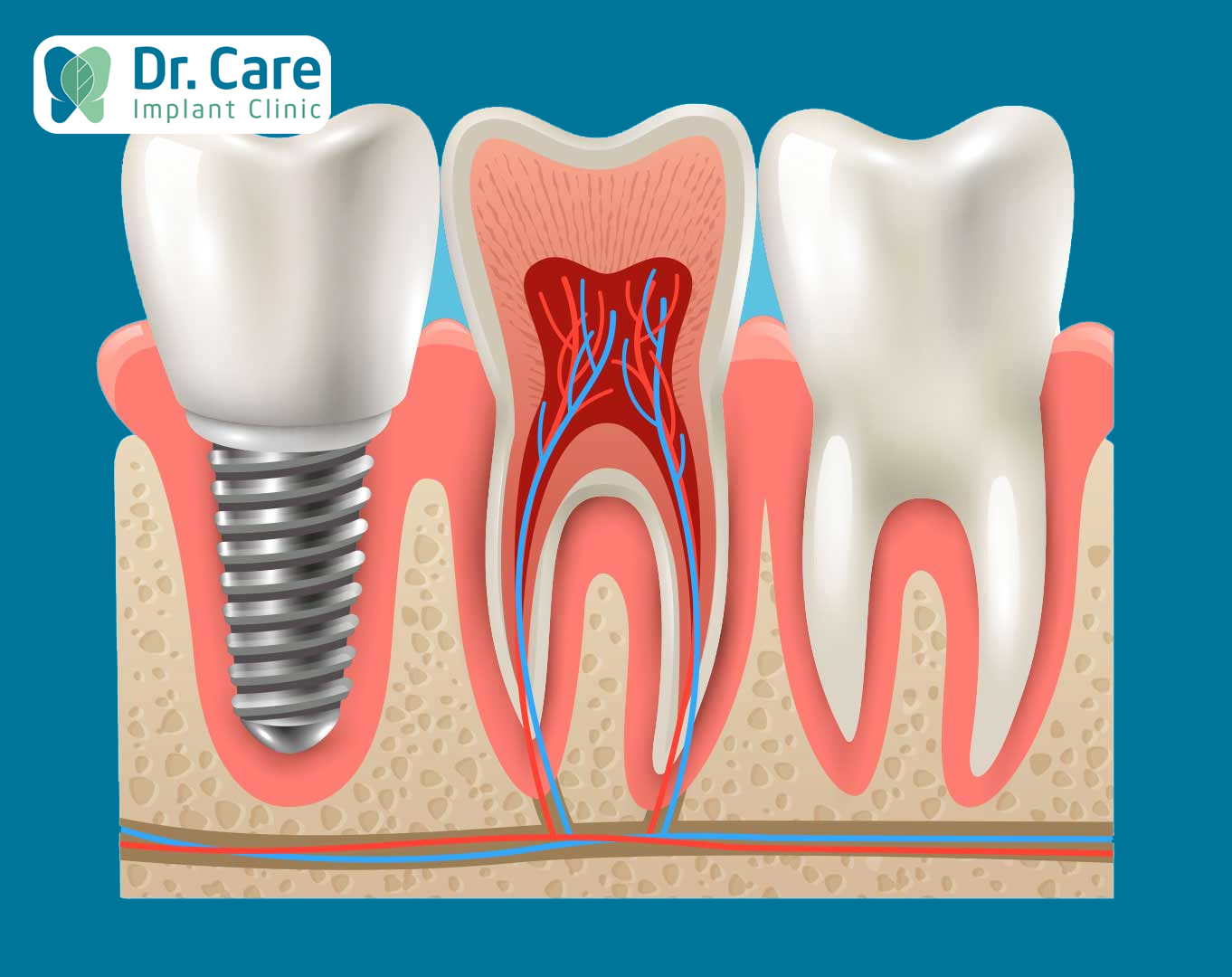 Trồng răng Implant truyền thống là gì