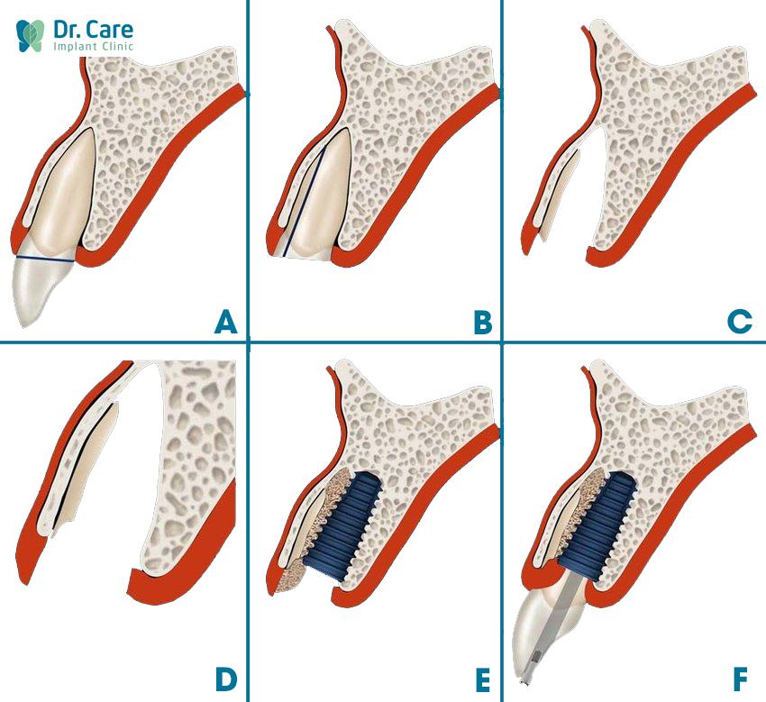 Khi thực hiện kỹ thuật Socket Shield, các bác sĩ sẽ giữ lại mảng xương hàm phía ngoài, sau đó sẽ đặt trụ Implant vào trong ổ mất răng. Việc giữ lại mảng xương này giúp răng Implant sau phục hình sẽ đạt được thẩm mỹ gần với răng thật nhất.