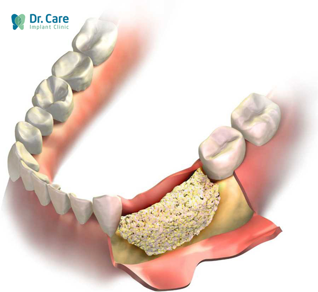 Các loại màng xương sử dụng trong cấy ghép răng Implant